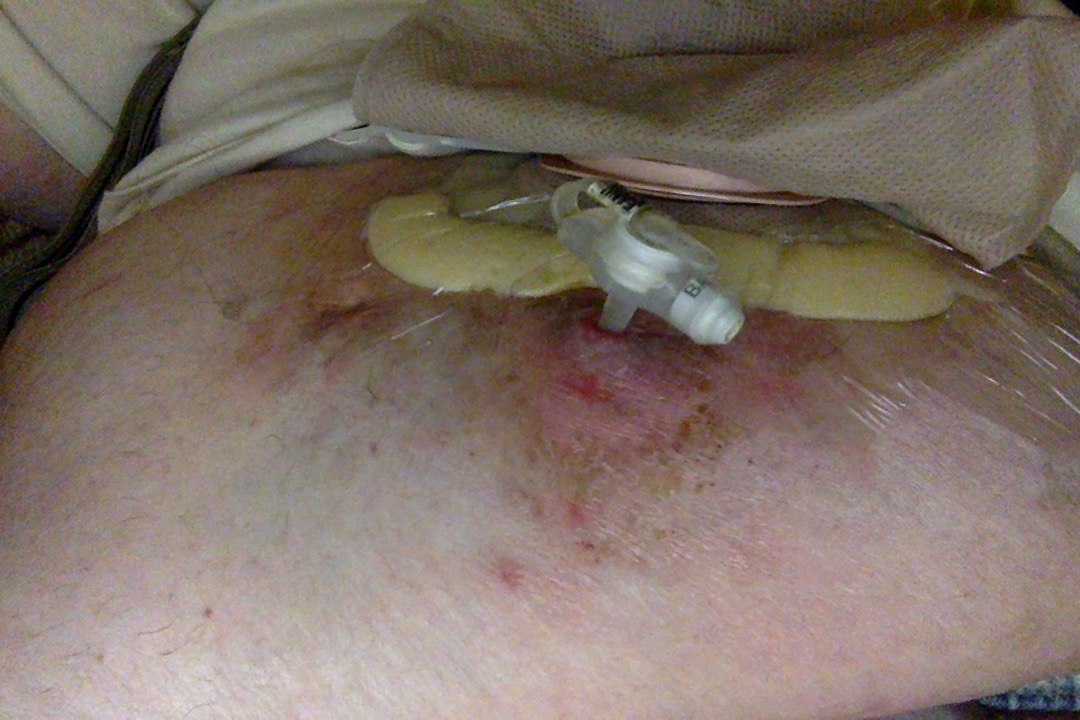 A MIC-KEY button J-tube on a large somewhat scarred-up belly with ostomy bag behind it.